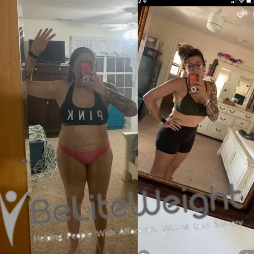 Weight Loss Surgery Before And After
